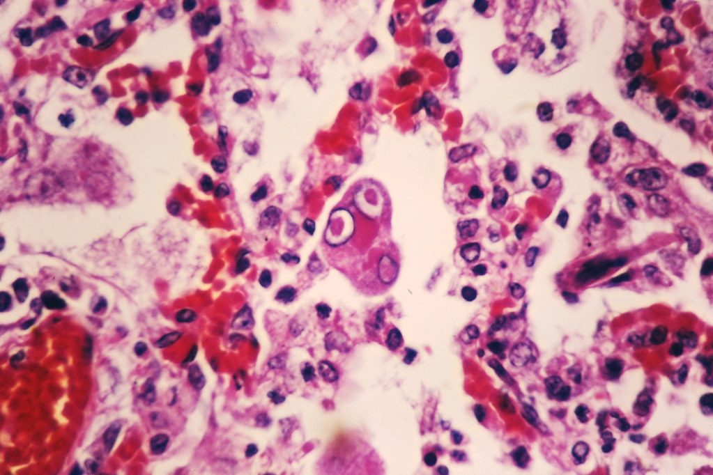 Measles case reported in Adams County - WOWO News/Talk 92.3 FM and 1190 AM